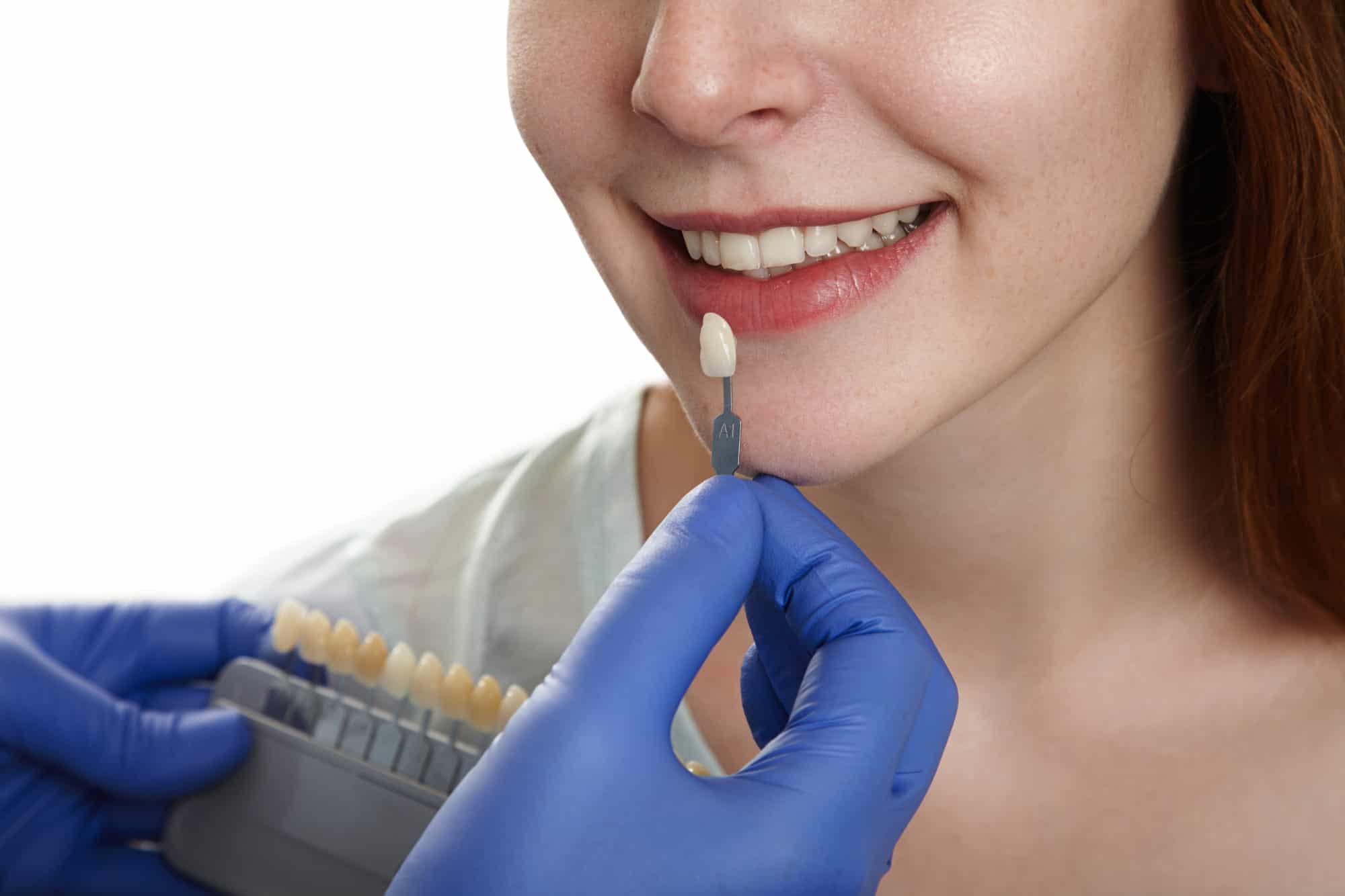 Dental bonding treatment at Rose City Dental in Windsor, Ontario