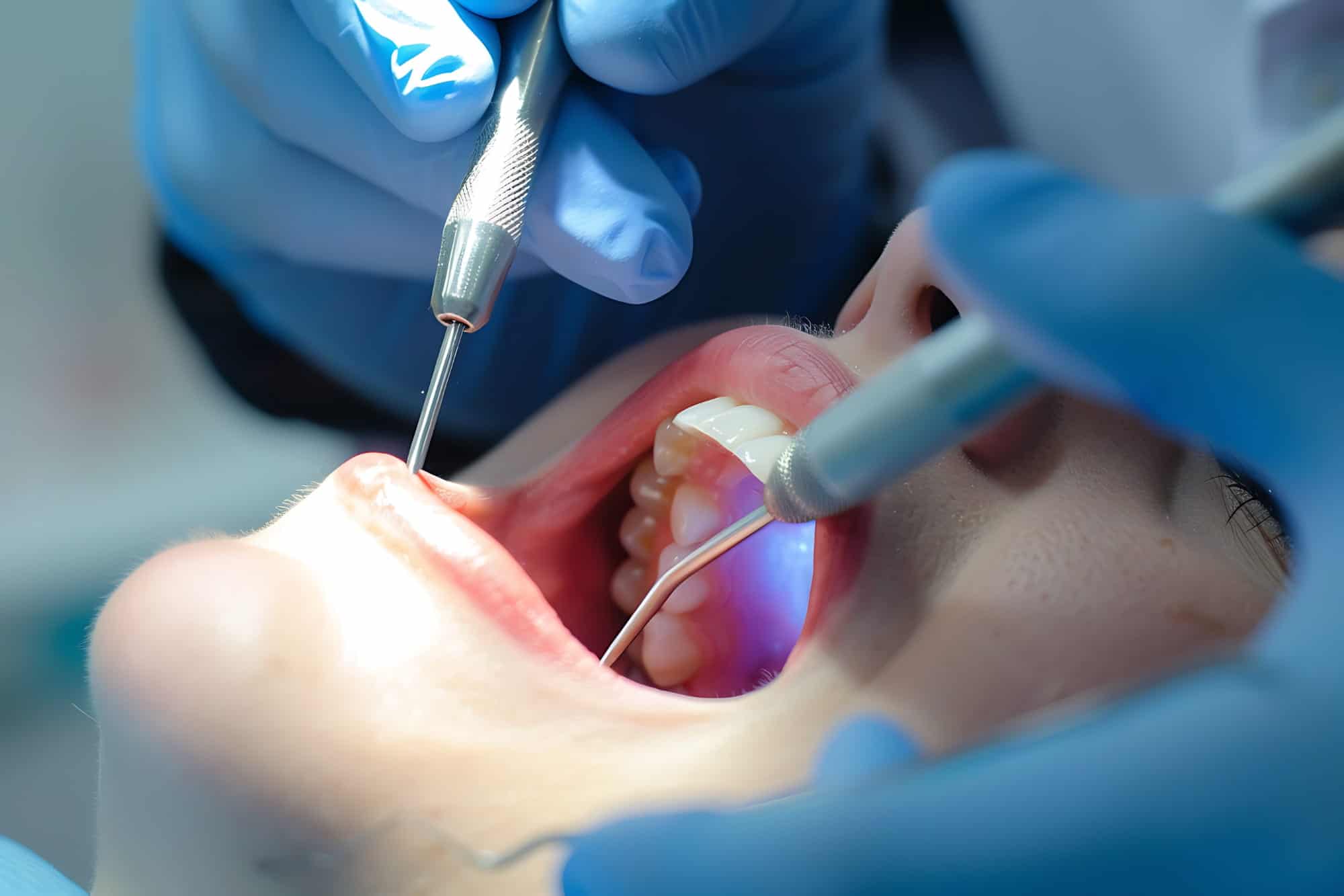 Root canal treatment at Rose City Dental in Windsor, Ontario